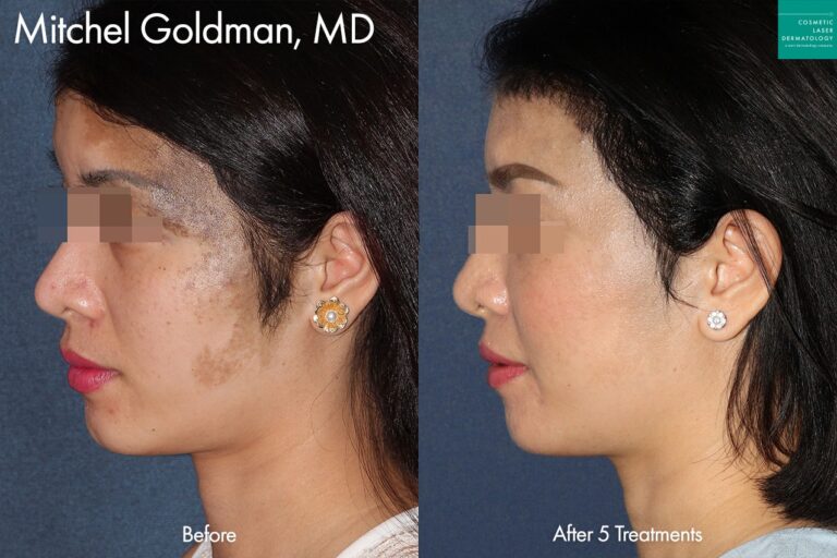 PicoSure to treat Nevus of Ota by Dr. Goldman. After 5 treatments, her skin is visibly clearer.