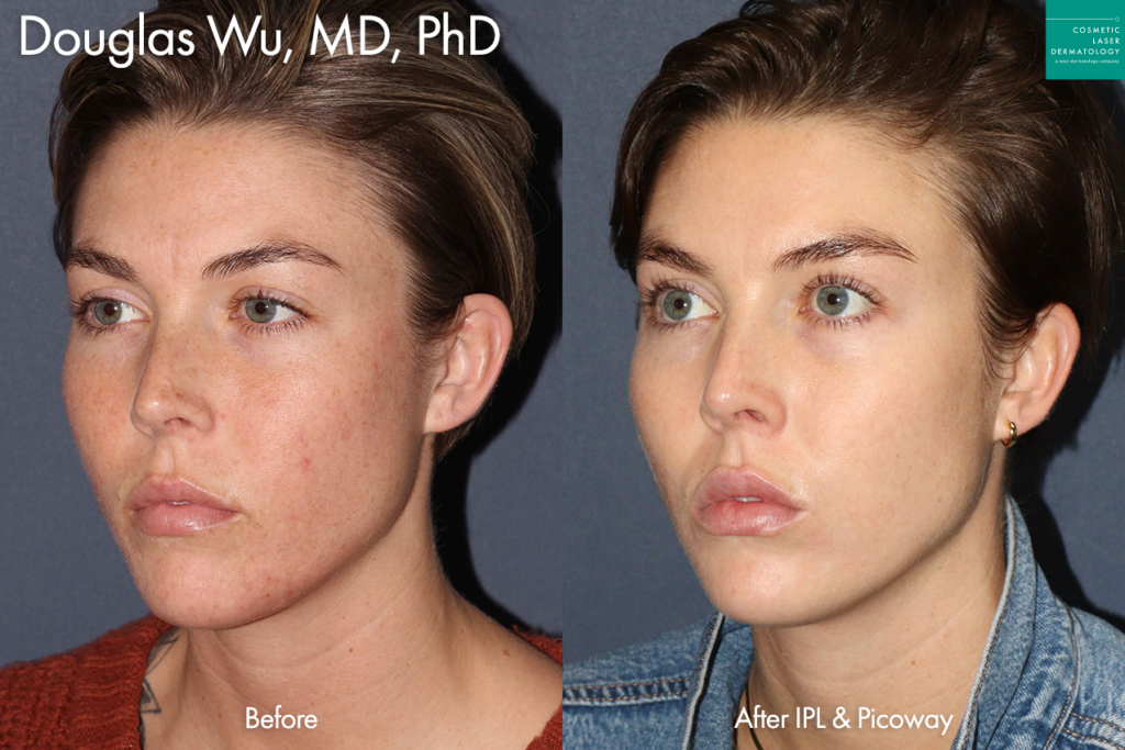 IPL treatment and PicoWay laser to treat brown spots and redness by Dr. Wu. After three treatment sessions, her redness and brown spots are almost fully gone.