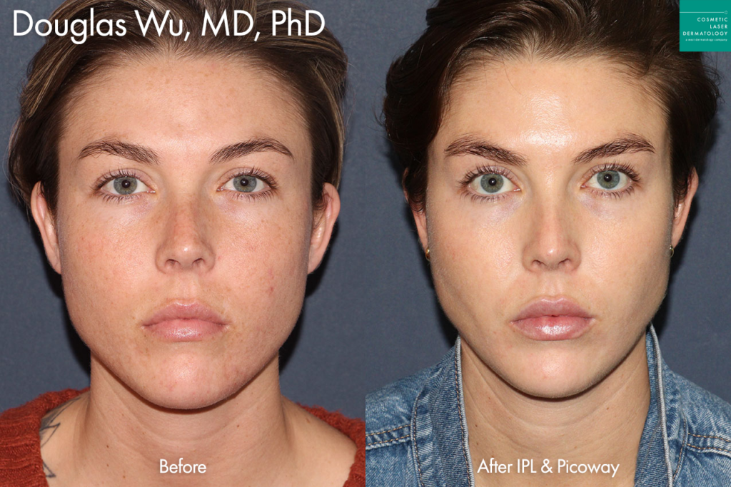 IPL treatment and PicoWay laser to treat brown spots and redness by Dr. Wu. Disclaimer: Results may vary from patient to patient. Results are not guarantee