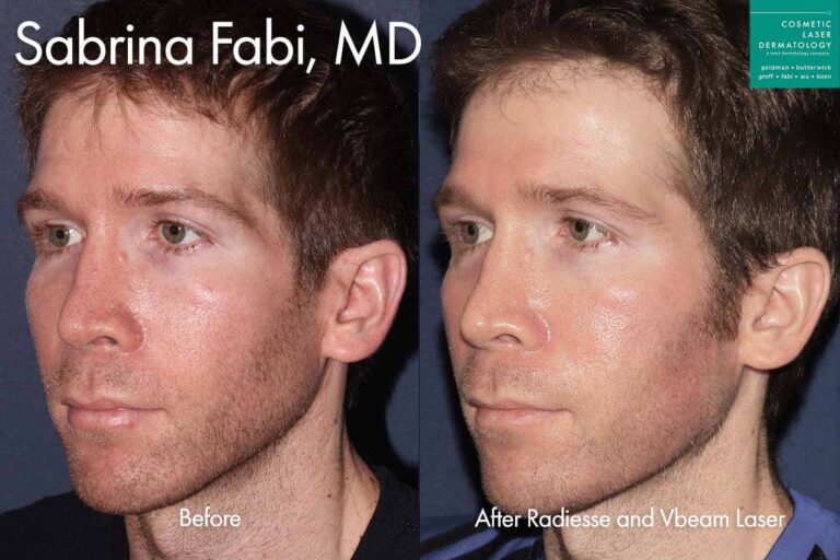 Radiesse and Vbeam laser to reduce redness and re-volumize face by Dr. Fabi. After treatment, the patient's face is much less red, and looks more balanced.