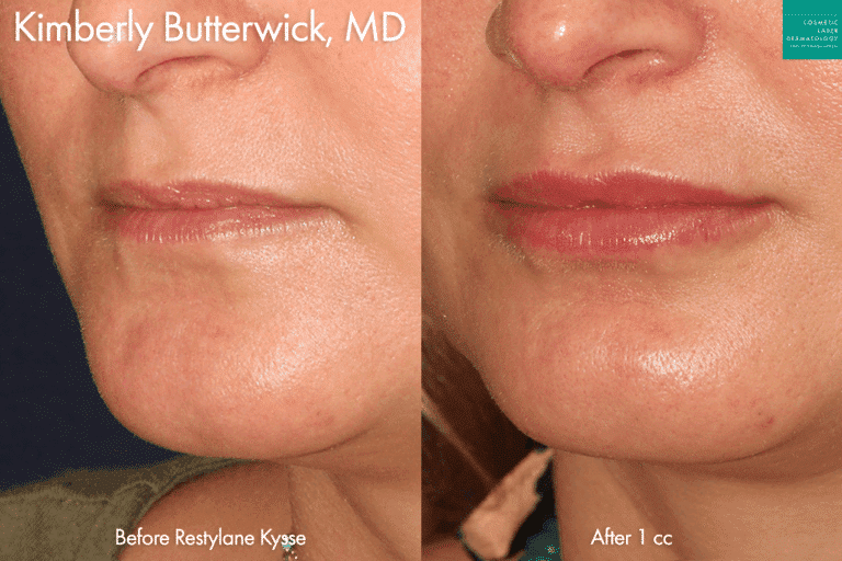 Restylane Kysse to plump up the lips by Dr. Butterwick. After treatment, lips are fuller and shapelier.