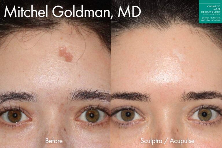 Acupulse and Sculptra to treat forehead scar by Dr. Goldman. After treatment, the scar is barely visible.