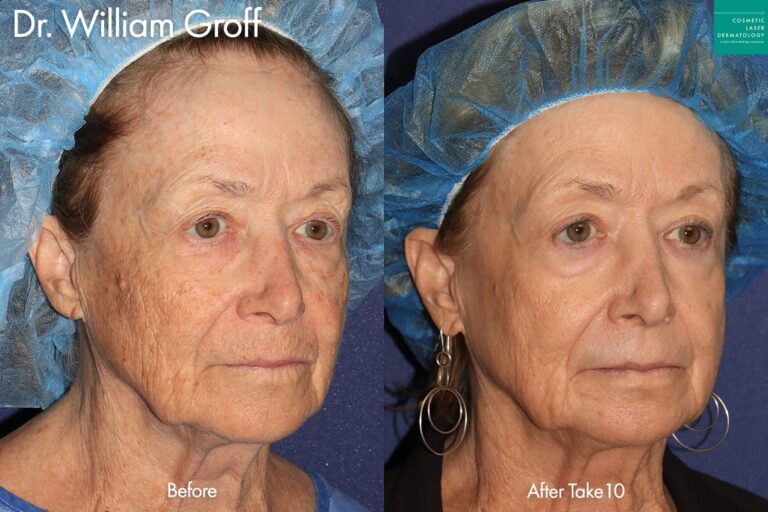 Take 10 treatment to reverse aging signs by Dr. Groff. After treatment, lines are reduced, skin is smoother, and brown spots are minimized.