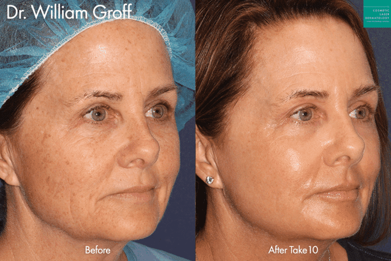 Take 10 treatment to rejuvenate the appearance by Dr. Groff. After treatment, skin is brighter, clearer, and more youthful.