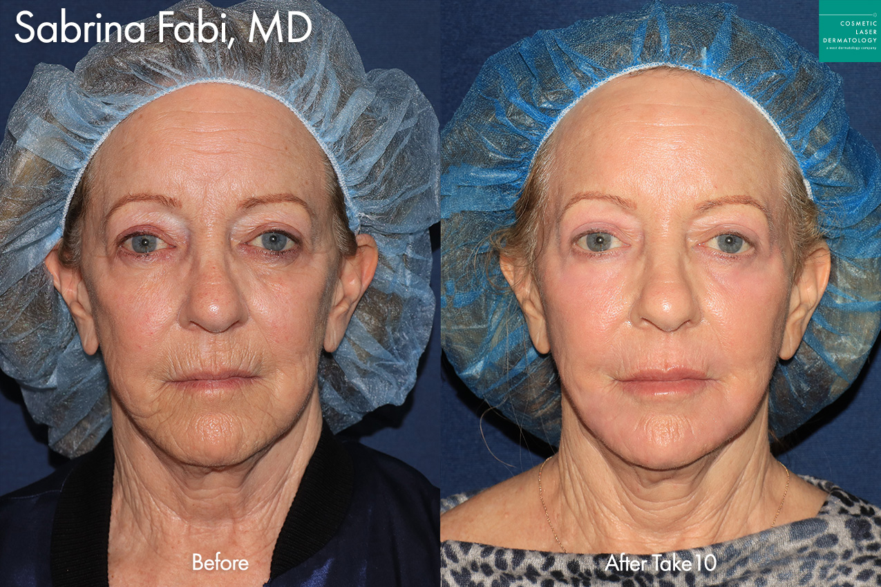 cosmetic laser dermatology take10 before and after in san diego ca