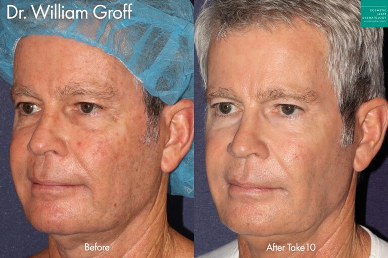 Take 10 for a more youthful appearance by Dr. Groff. After laser treatment, patient's face is smoother with fewer lines and signs of sun damage.