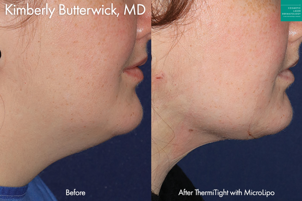 ThermiSculpt³ to treat double chin; before and after