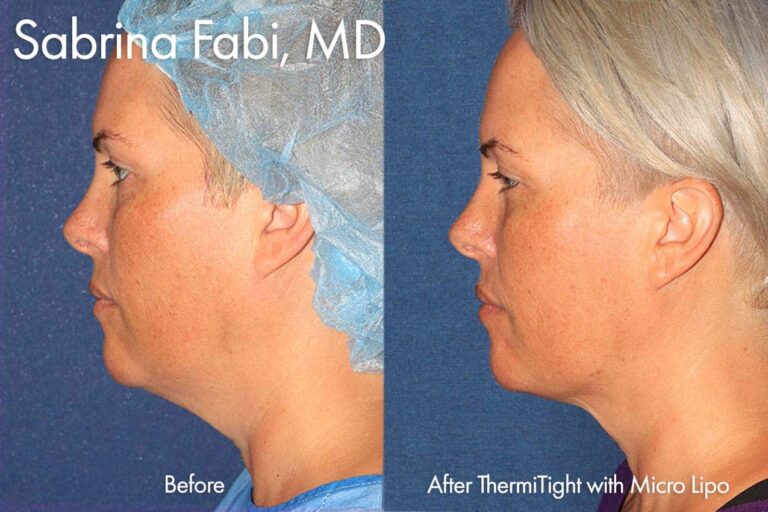 ThermiTight with MicroLipo to contour the neck and chin by Dr. Fabi. After treatment, the patient's submental fat is significantly reduced.