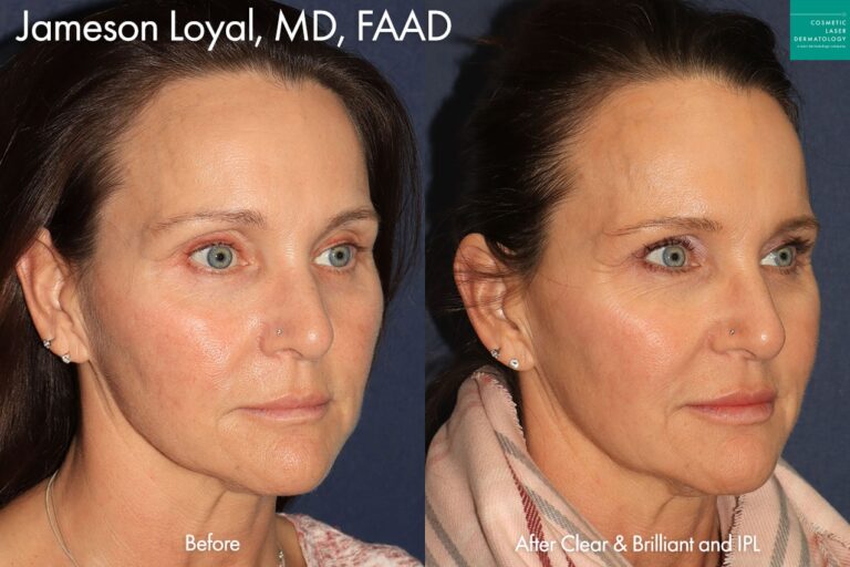 IPL and Clear & Brilliant for skin rejuvenation by Dr. Loyal. After treatment, her skin is much more even and the overall skin quality is improved.