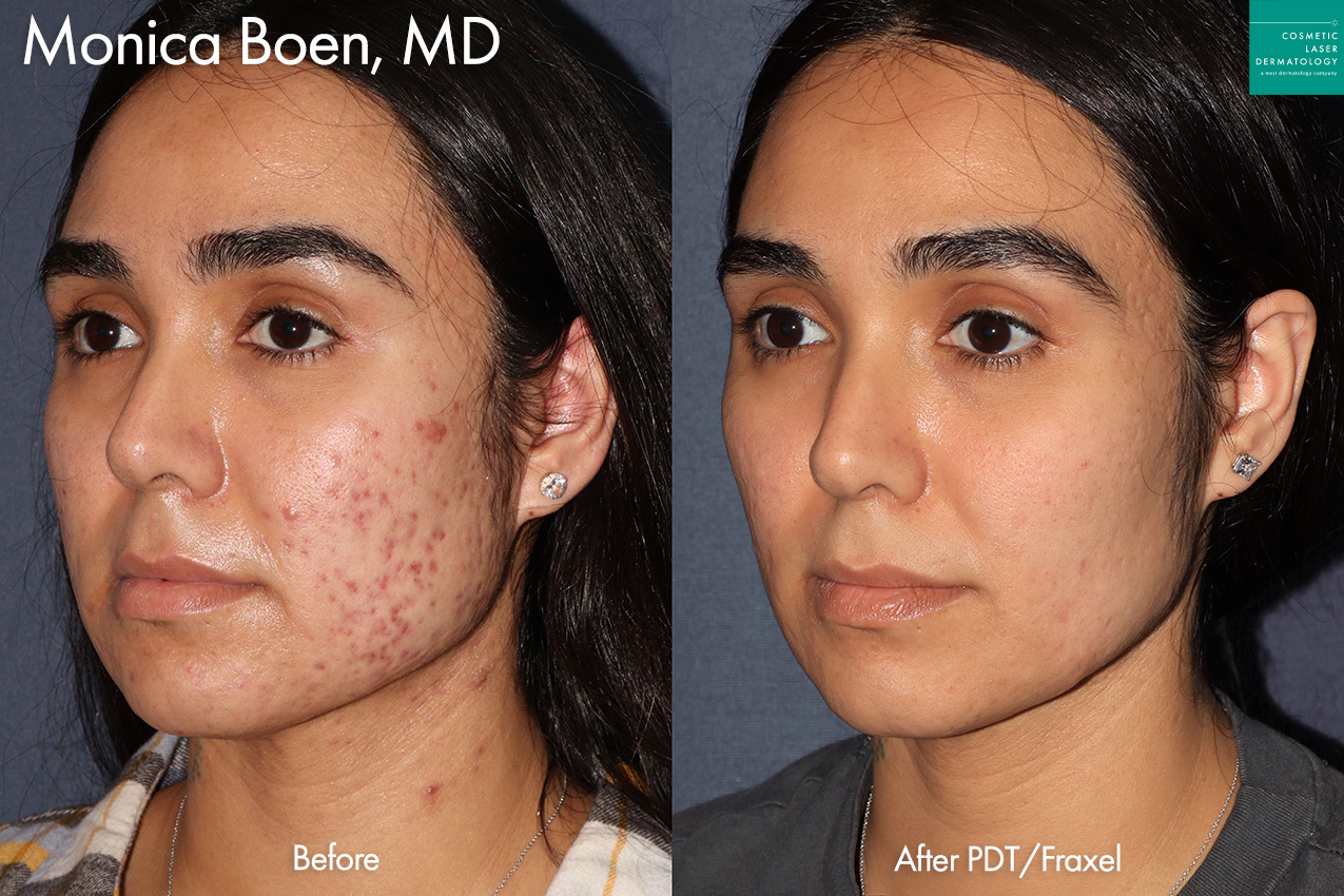 PDT and Fraxel to treat acne scars by Dr. Boen. After treatment, the acne scarring is significantly reduced and her skin is much more clear.