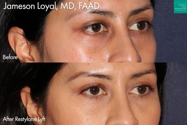Restylane Lyft to fill tear troughs by Dr. Loyal. After treatment, the patient's tear troughs look more full and less tired.