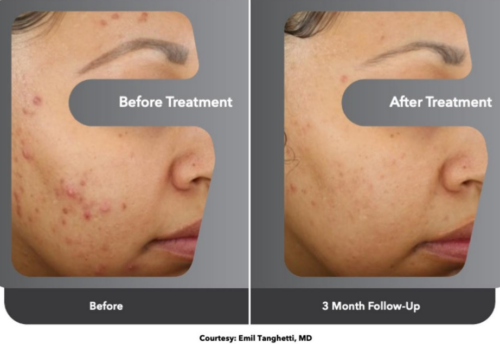 cosmetic laser dermatology accure laser before and after san diego ca