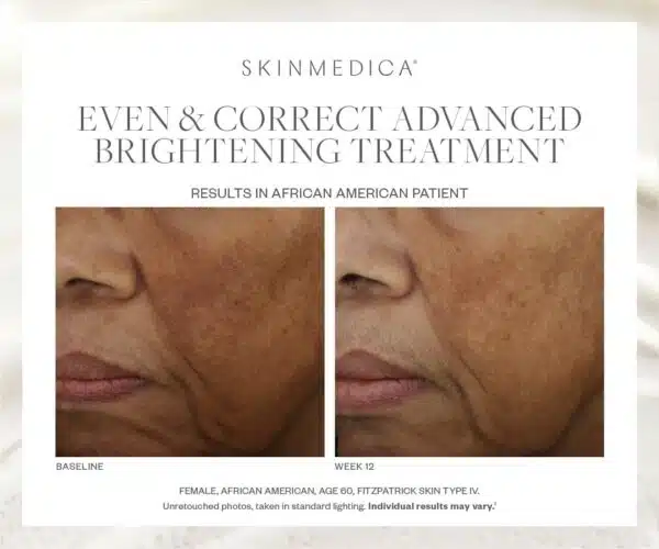 SkinMedica Even & Correct Advanced Brightening Treatment - Image 3