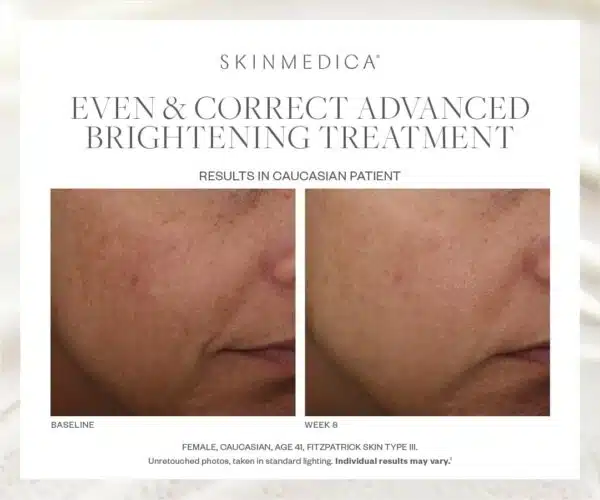 SkinMedica Even & Correct Advanced Brightening Treatment - Image 2