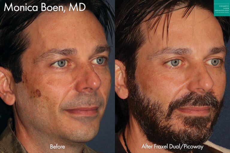 Fraxel Dual and Picoway to treat brown spots by Dr. Boen. After treatment, patient's skin is much more even.