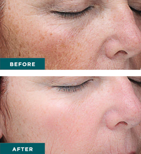 clderm before and after VI peel treatment san diego ca