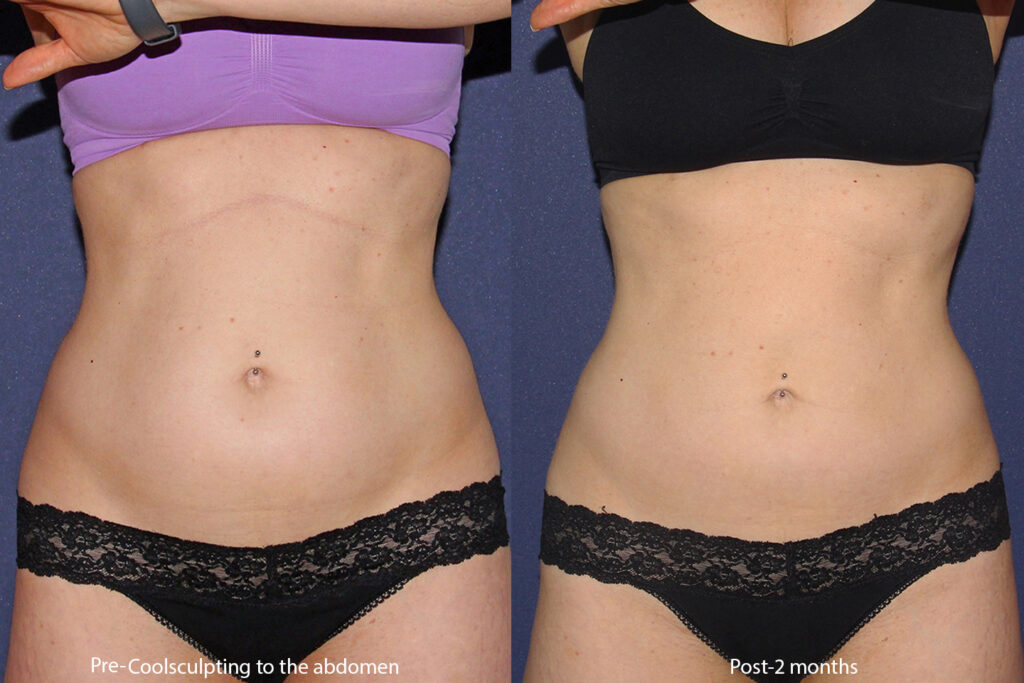 Non-Surgical Body Contouring vs. Liposuction: Which Is Right For You?