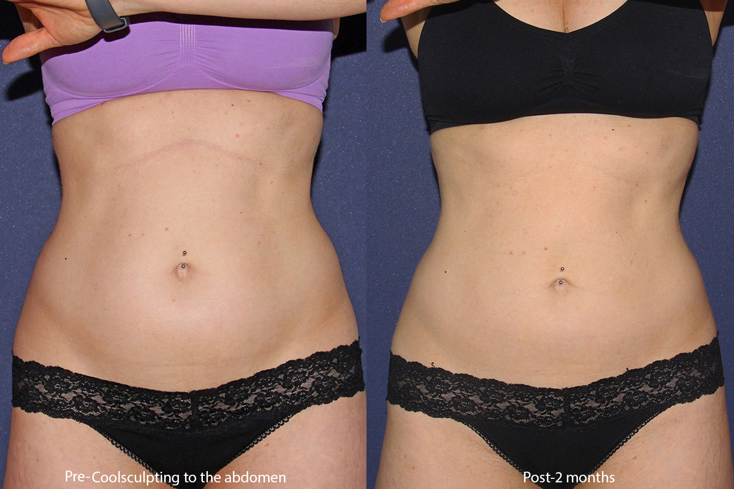 CoolSculpting™ vs. Liposuction 