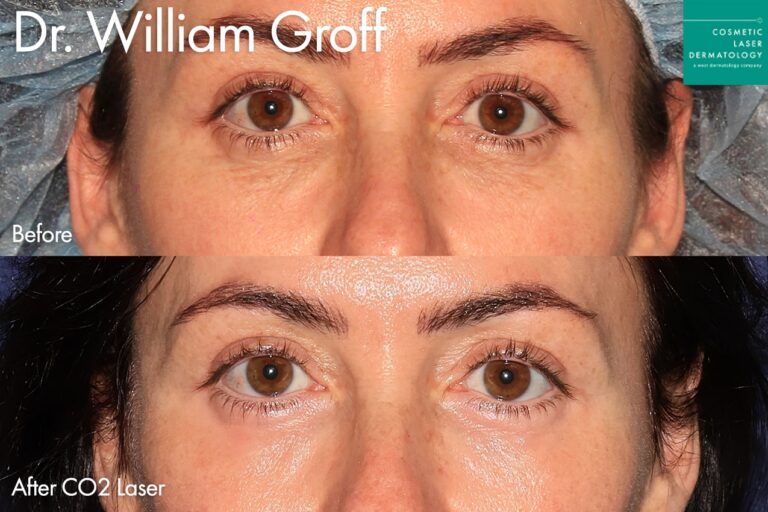 Laser resurfacing to treat undereye wrinkles by Dr. Groff. After treatment, the patient's undereye area looks much more youthful.