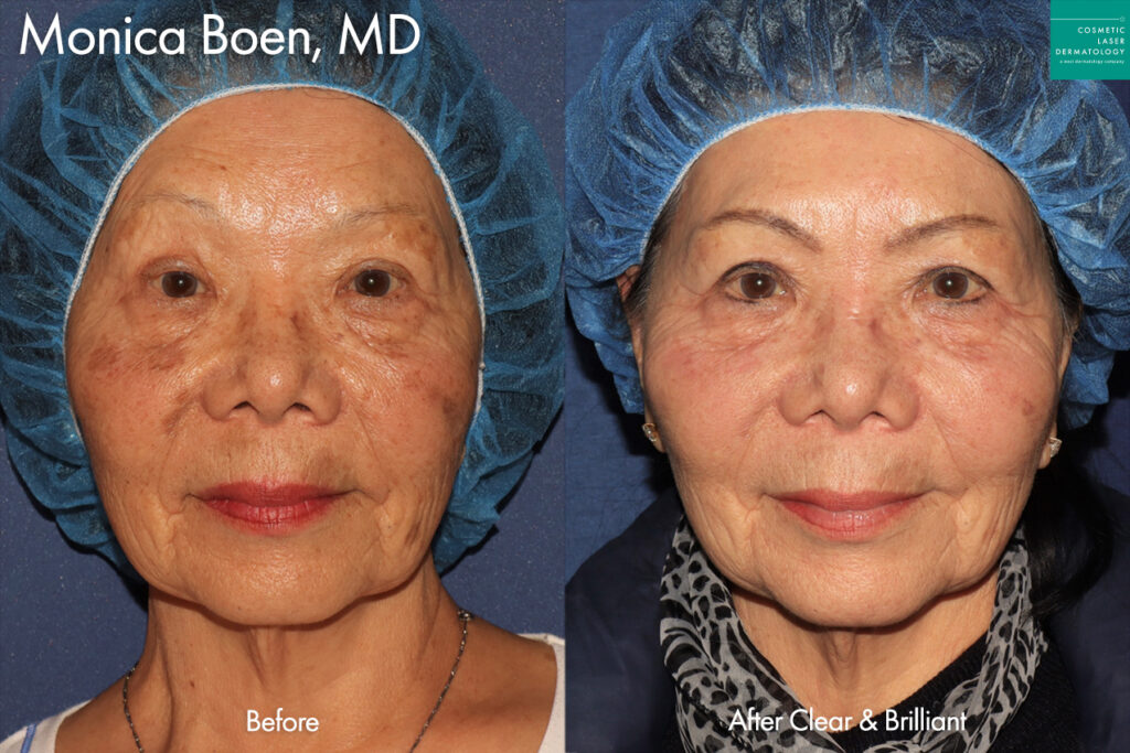 Clear & Brilliant to treat sun damage by Dr. Boen. After treatment, the patient's sun damage has greatly improved.