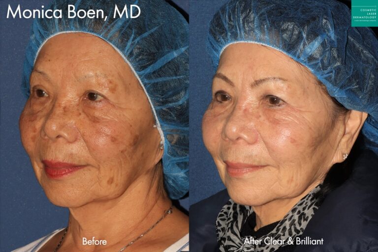 Clear & Brilliant to treat sun damage by Dr. Boen. After treatment, the patient's sun damage has greatly improved.