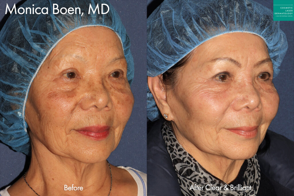 Clear & Brilliant to treat sun damage by Dr. Boen. After treatment, the patient's sun damage has greatly improved.