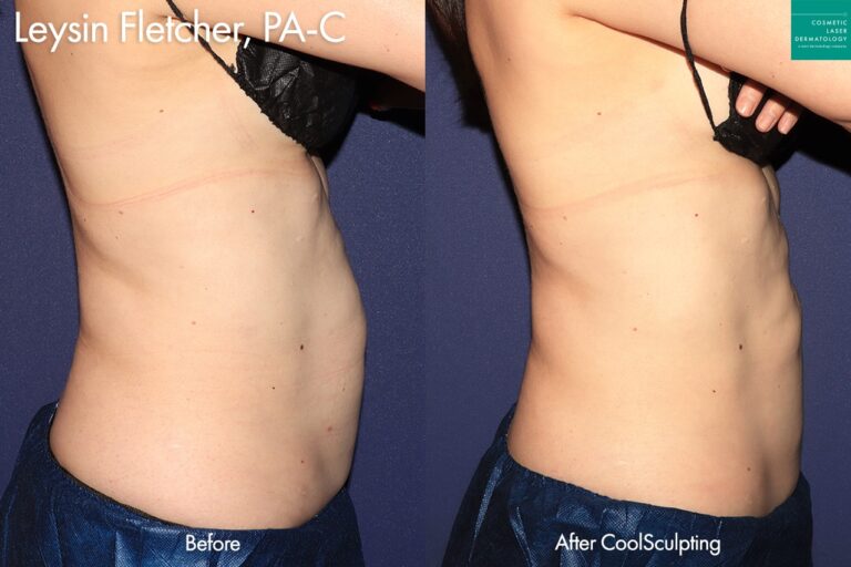 CoolSculpting to trim the abdomen by Leysin Fletcher, PA-C. After treatment, the patient's abdomen is much more toned.