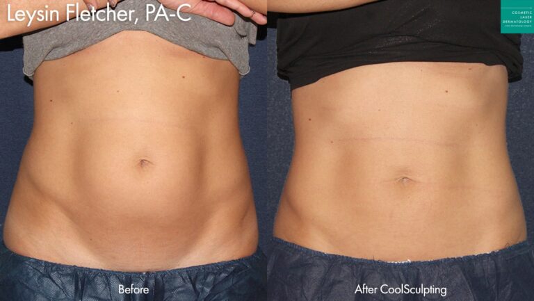 CoolSculpting to trim the abdomen by Leysin Fletcher, PA-C. After treatment, the patient's abdomen is much more toned.