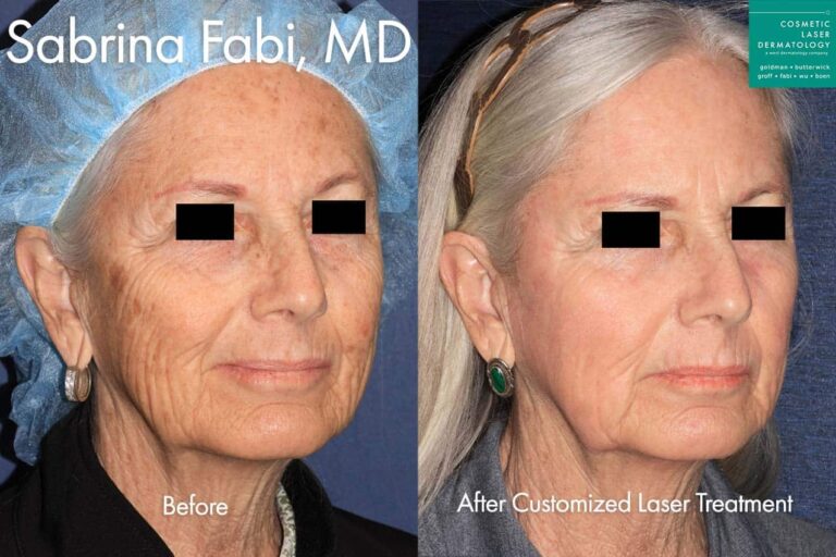 Customized laser treatment for total rejuvenation by Dr. Fabi. After treatment, the patient looks much more youthful, healthy, and has much more even skin tone.