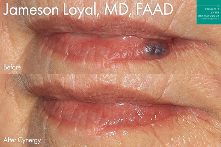 Cynergy to treat venous lake by Dr. Loyal. After treatment, the patient's lips look spotless.