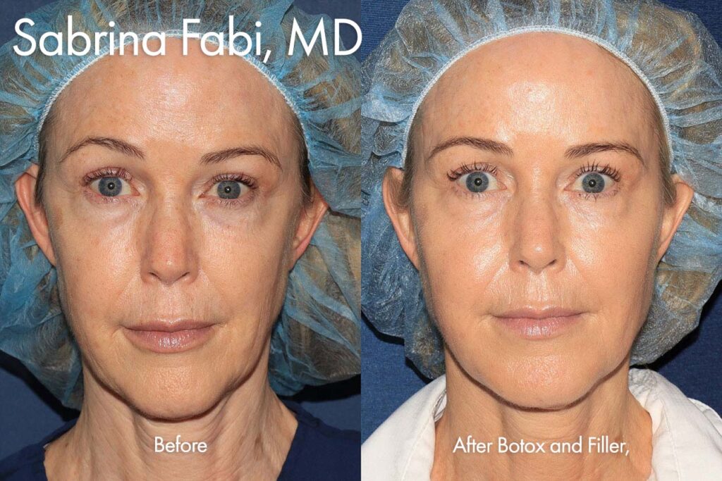 Filler and Botox for a refreshed appearance by Dr. Fabi. After treatment, the patient's overall appearance has improved.