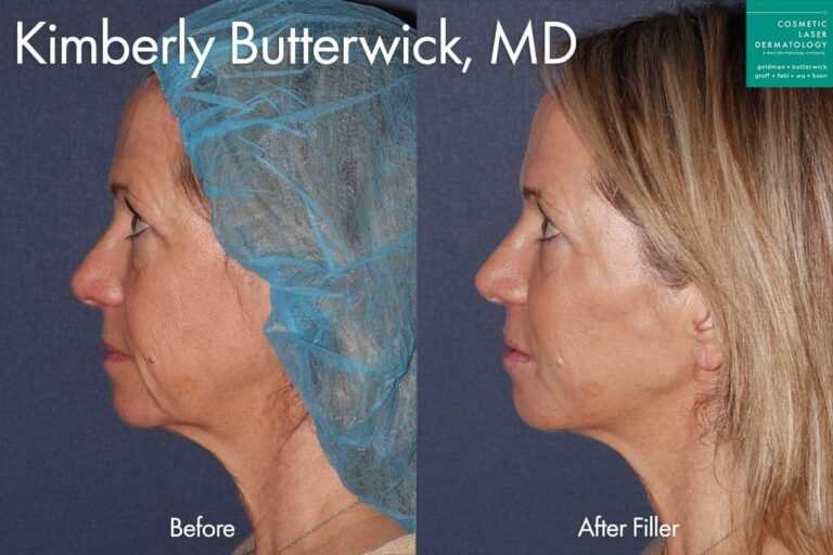 Filler to enhance appearance by Dr. Butterwick. After treatment, the patient's face is much more lifted and her overall appearance is enhanced.