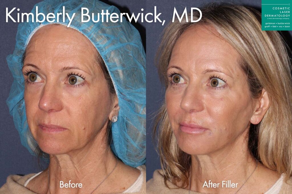 Filler to enhance appearance by Dr. Butterwick. Disclaimer: Results may vary from patient to patient. Results are not guaranteed.