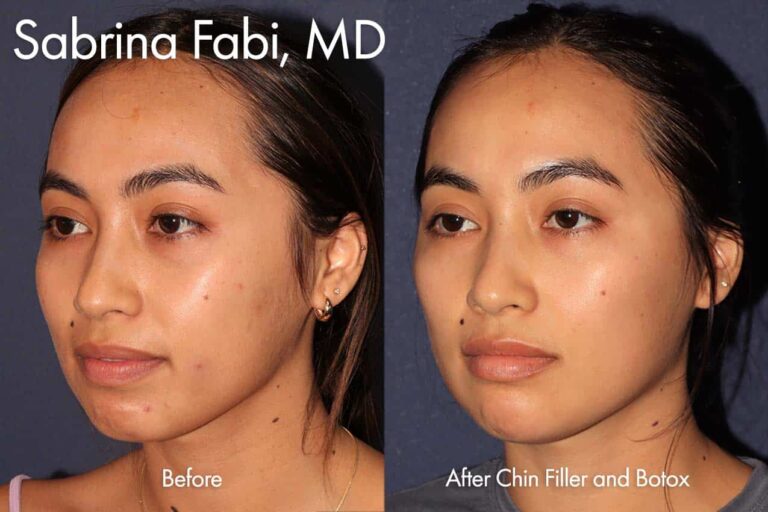 Filler and Botox for facial shaping by Dr. Fabi. After treatment, her face is much more balanced.