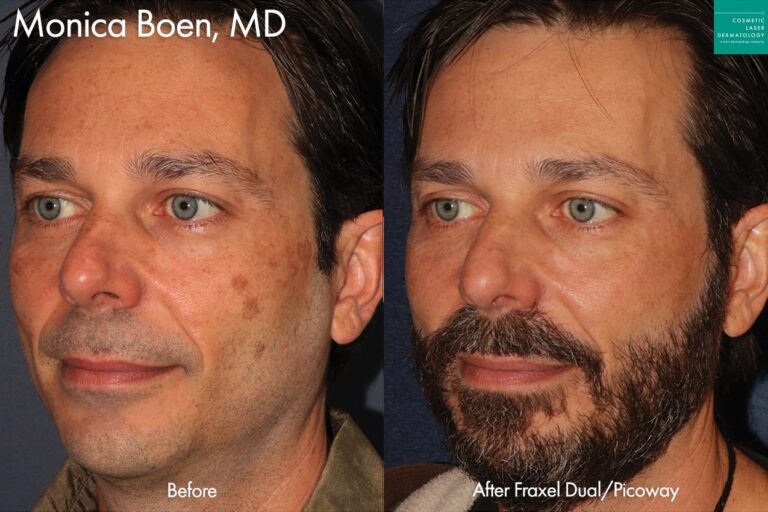 Fraxel Dual and Picoway to treat brown spots by Dr. Boen. After treatment, the patient's brown spots are gone and his skin tone is much more even.