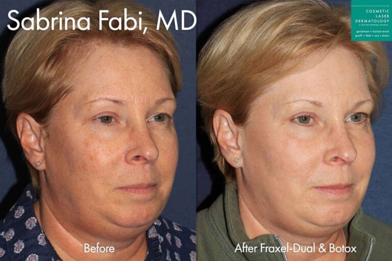 Fraxel Dual and Botox to refresh appearance by Dr. Fabi. After treatment, the patient's skin tone is even and her wrinkles are less pronounced.