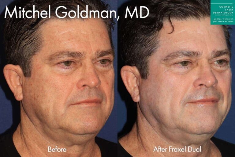 Fraxel Dual to treat brown spots by Dr. Goldman. After treatment, the patient's skin tone is much more even.