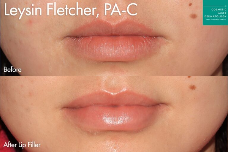 Juvederm for plump lips by Leysin Fletcher, PA-C. After treatment, the patient's lips are much more naturally plump.