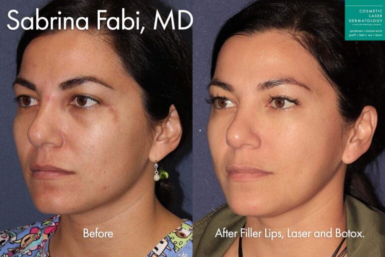 Lasers, Lip Filler, and Botox for facial harmony by Dr. Fabi. After treatment, the patient's appearance is overall much more enhanced.