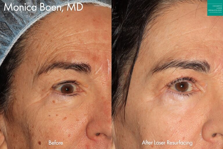 Laser resurfacing for rejuvenation by Dr. Boen. After treatment, the patient's skin is much more clear and the wrinkles are less pronounced.