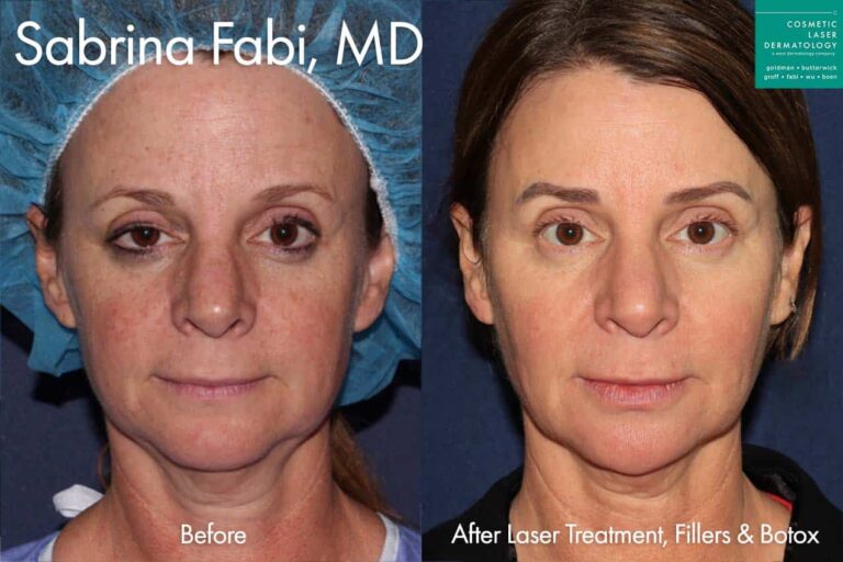 Lasers, Filler, and Botox for a rejuvenated appearance by Dr. Fabi. After treatment, the patient's face looks much more balanced and lifted.