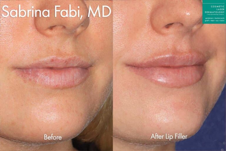 Filler to plump lips by Dr. Fabi. After treatment, her lips look more naturally plump.