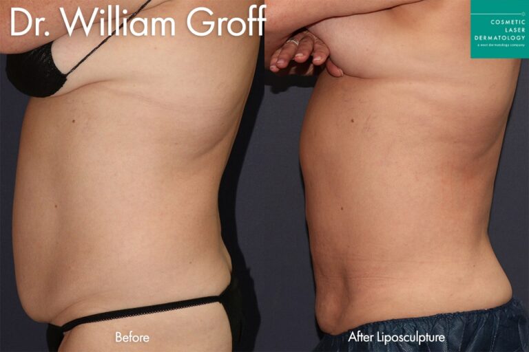 Liposculpture to trim abdomen fat by Dr. Groff. After treatment, the patient's abdomen is much slimmer.