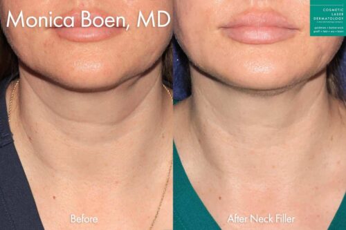 Filler to treat neck lines by Dr. Boen. After treatment, the patient's neck lines are much less prominent.