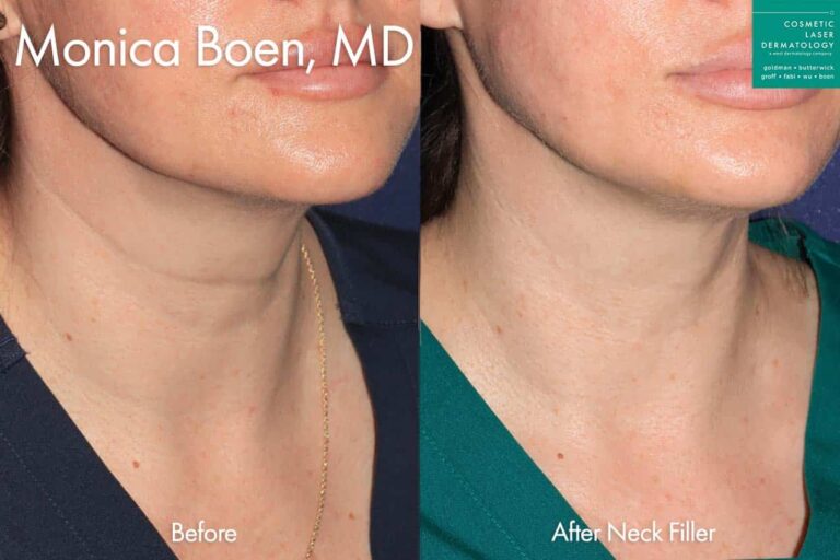Filler to treat neck lines by Dr. Boen. After treatment, the patient's neck lines are much less prominent.