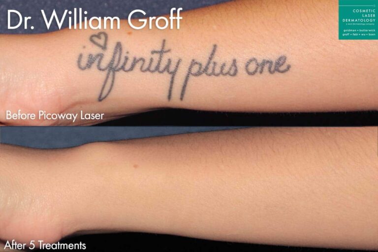 Picoway laser for Tattoo Removal by Dr. Groff. After treatment, the tattoo has disappeared