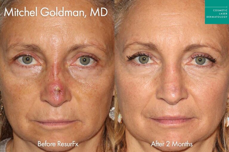 ResurFX to treat scar on nose by Dr. Goldman. After treatment, the patient's scar has almost disappeared.