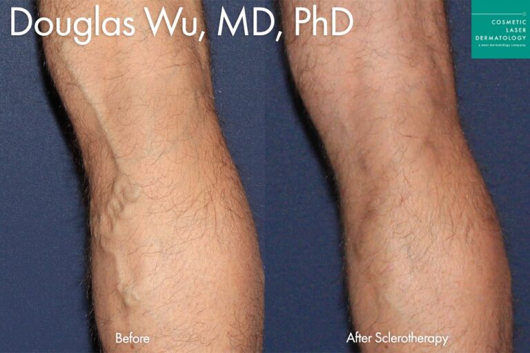 Sclerotherapy to treat varicose veins by Dr. Wu. After treatment, the patient's vein has greatly reduced.