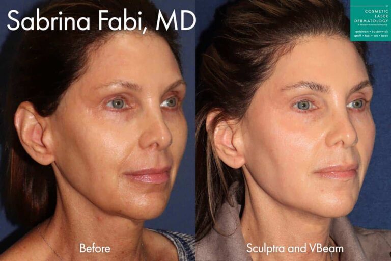 Sculptra and Vbeam to enhance appearance by Dr. Fabi. After treatment, the patient's skin is much more even and overall lifted.