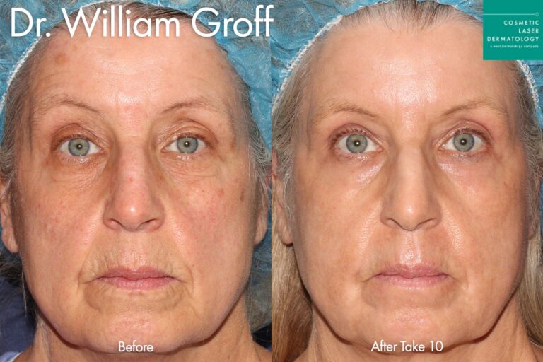 Take 10 to reverse aging signs by Dr. Groff. After treatment, the patient is totally rejuvenated, looking ten years younger.